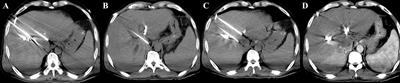 Novel irreversible electroporation ablation (Nano-knife) versus radiofrequency ablation for the treatment of solid liver tumors: a comparative, randomized, multicenter clinical study